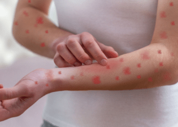 Sintomas de sarampo em adulto com manchas vermelhas pelo braço.