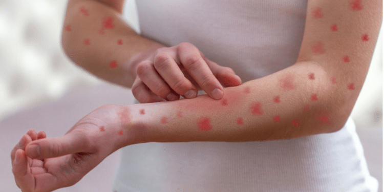 Sintomas de sarampo em adulto com manchas vermelhas pelo braço.