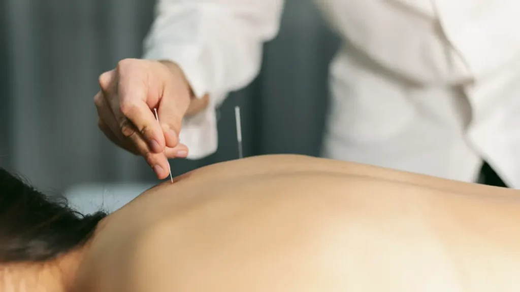 Sessão de acupuntura aplicada por profissional em ambiente clínico.