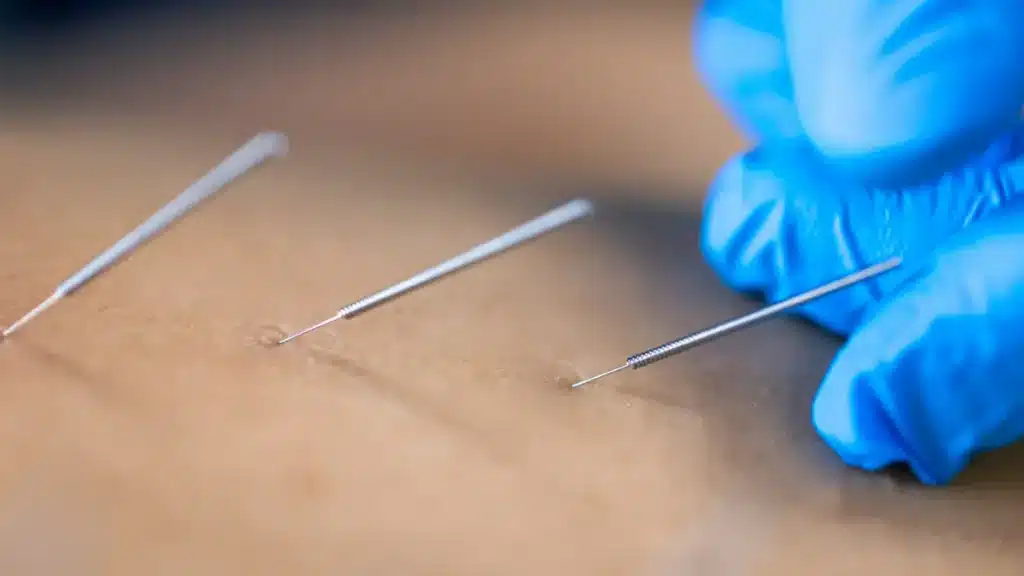 Agulhas de acupuntura aplicadas por profissional com luva azul.